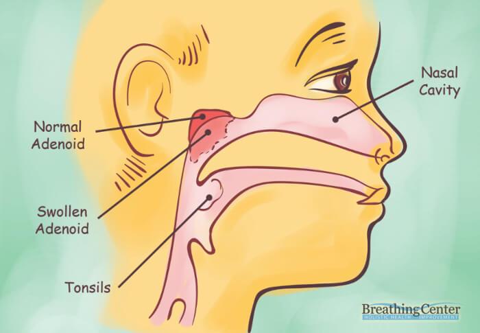 Removing the adenoids often leads to more serious defense reactions such as bronchial spasms