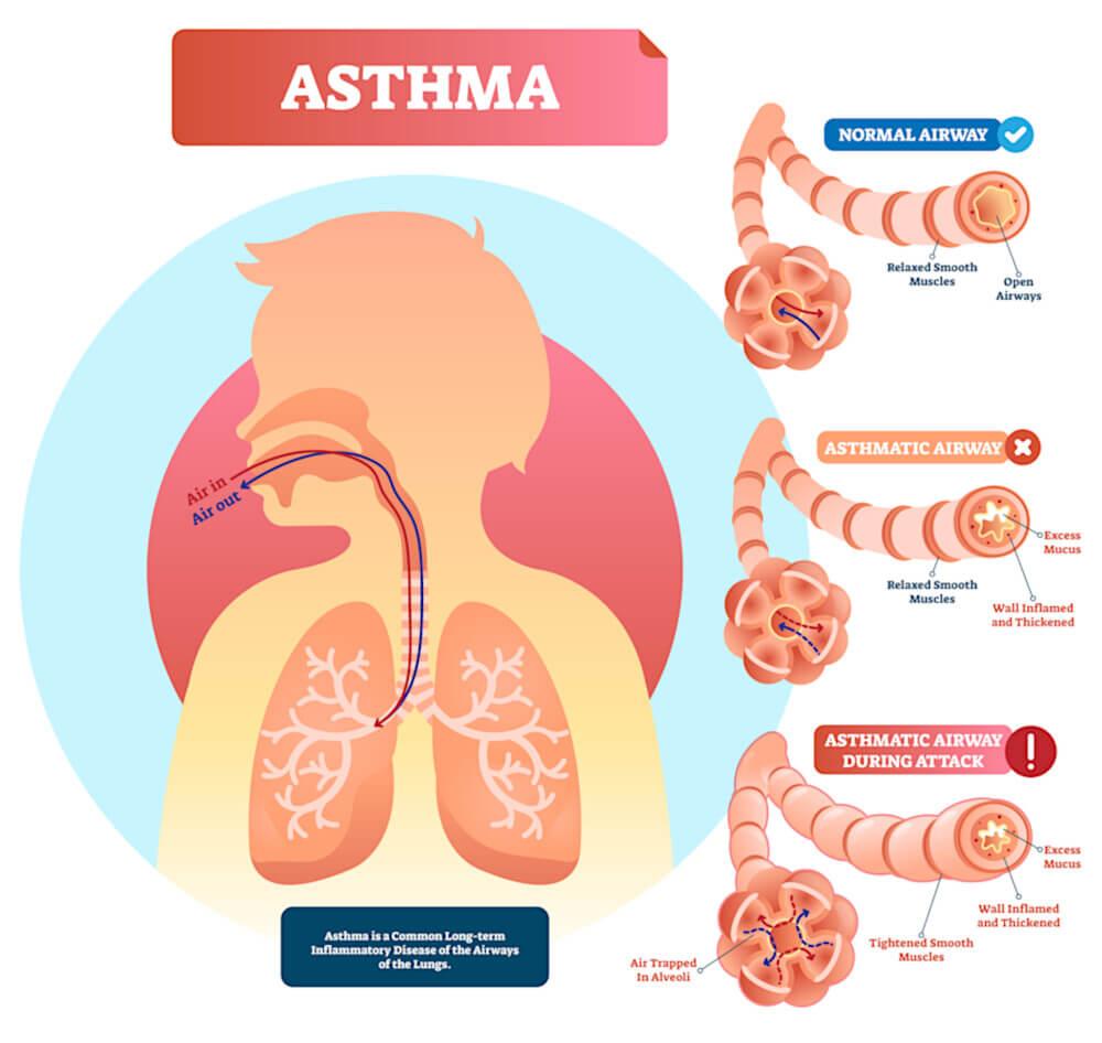 asthma-airways